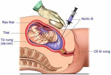 Đa ối khi mang thai có nguy hiểm không?