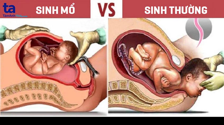 Nên sinh thường hay sinh mổ? Cách lựa chọn phương pháp sinh phù hợp