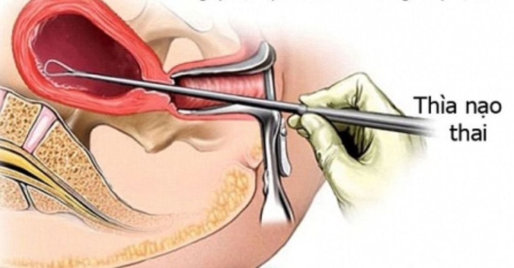 Nhận diện các triệu chứng sảy thai