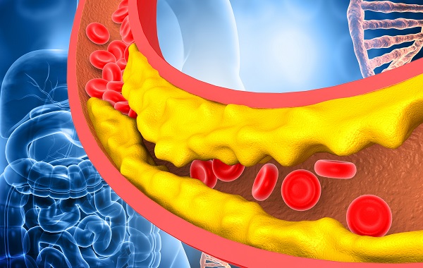 Xét nghiệm định lượng LDL cholesterol trong máu