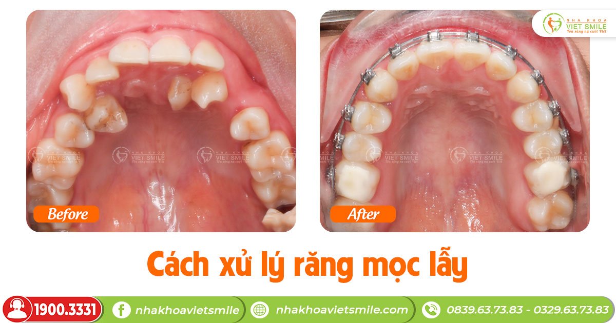 Răng mọc lẫy là gì? Xử lý ra sao?