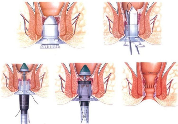 Bệnh trĩ từ A đến Z: Nguyên nhân, dấu hiệu và cách điều trị hiệu quả