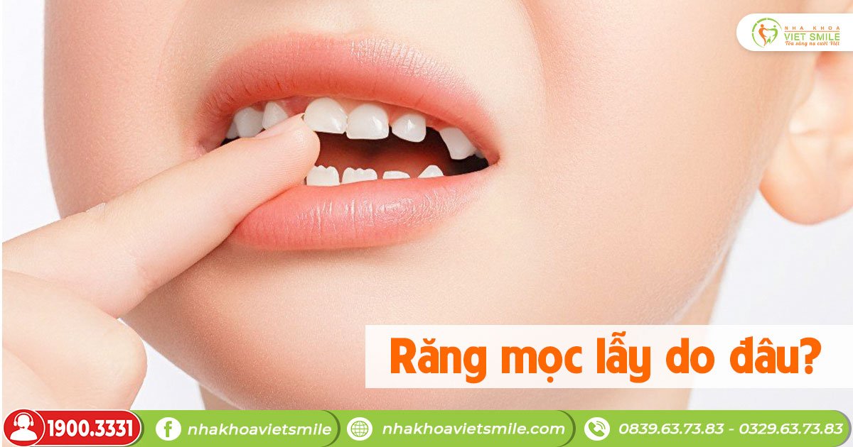 Răng mọc lẫy là gì? Xử lý ra sao?