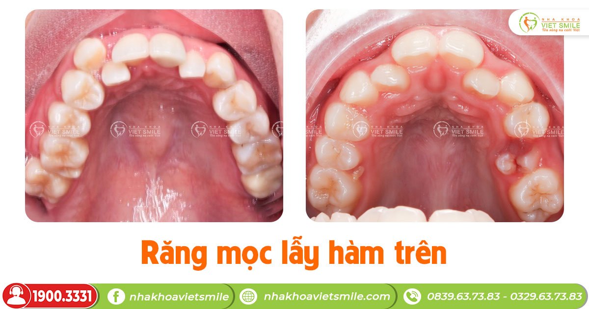 Răng mọc lẫy là gì? Xử lý ra sao?