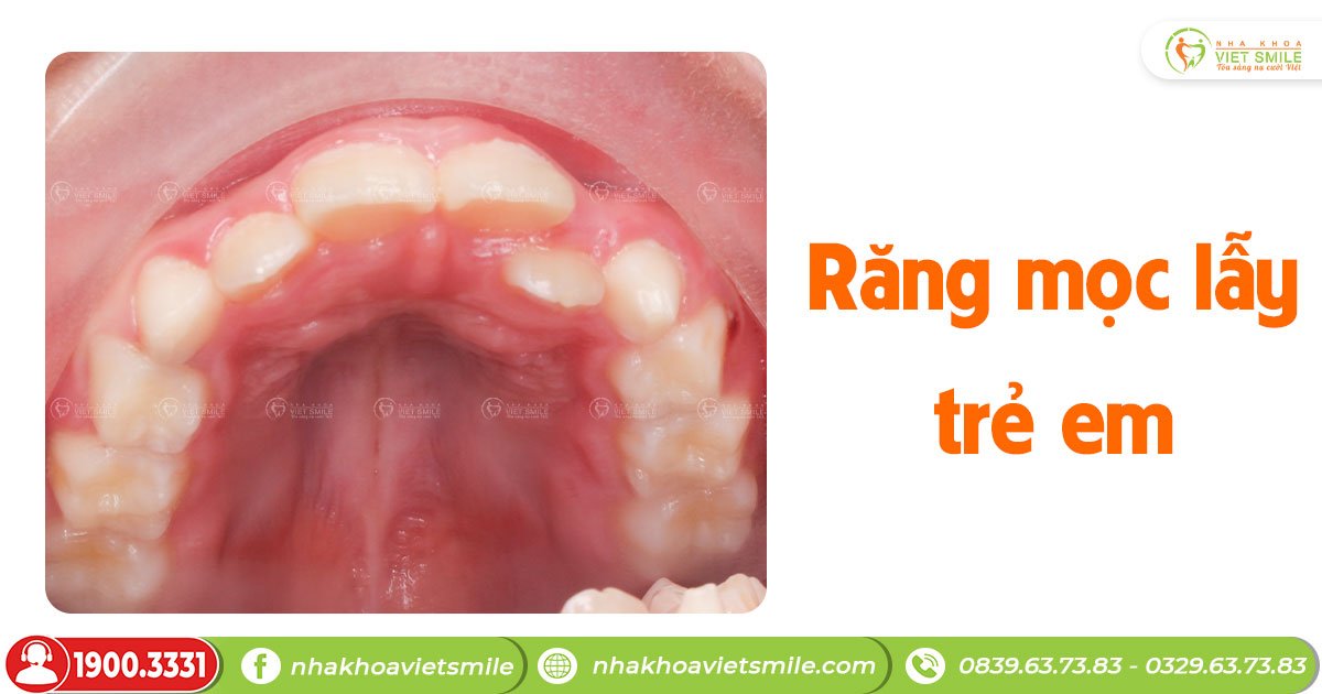 Răng mọc lẫy là gì? Xử lý ra sao?