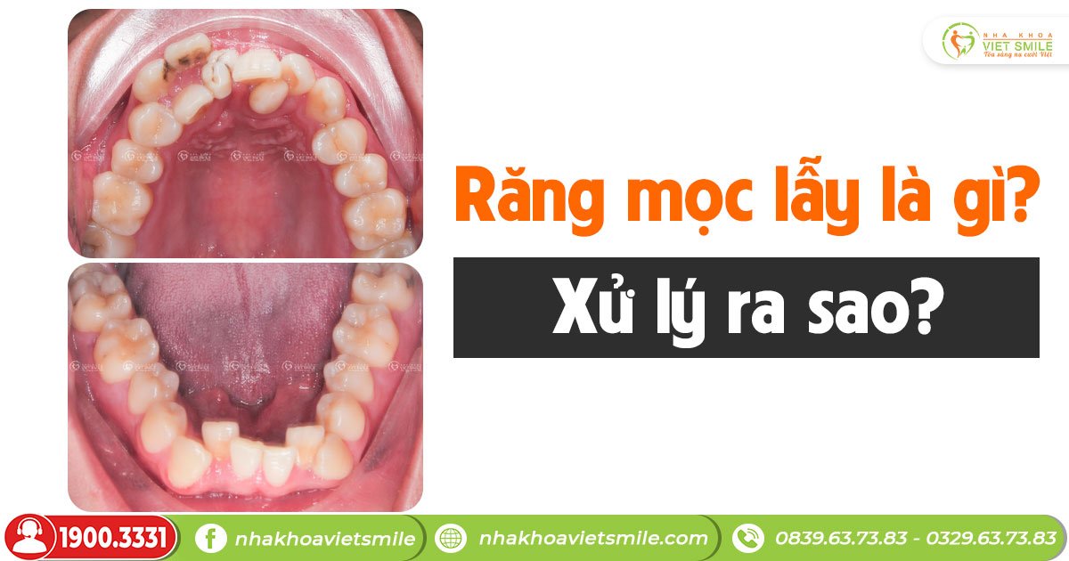 Răng mọc lẫy là gì? Xử lý ra sao?