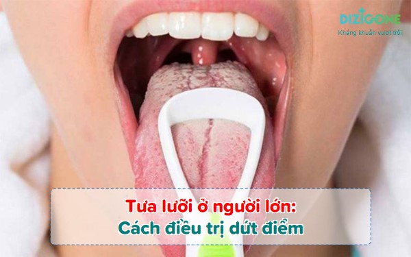 Cách điều trị tưa lưỡi ở người lớn dứt điểm