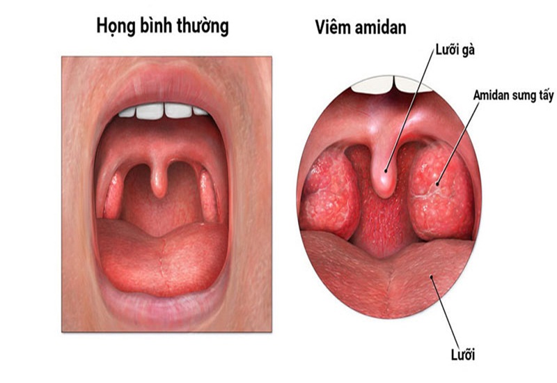 Cắt amidan có đau không? Người bệnh cần chú ý điều gì?