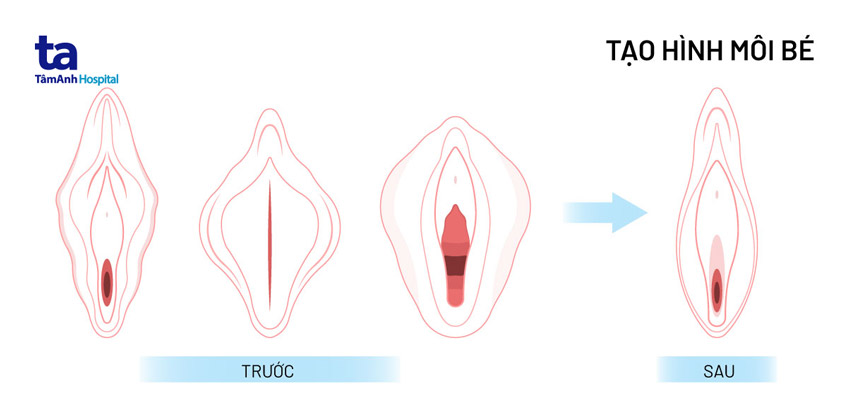 Môi bé là gì? Cấu tạo, vị trí và chức năng đối với cơ thể phụ nữ