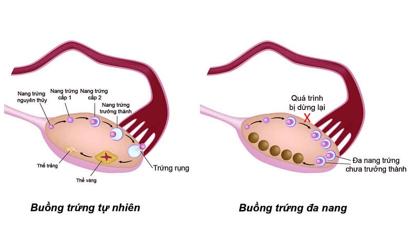 Lý giải hiện tượng “đến tháng” nhưng không có kinh nguyệt của nữ giới