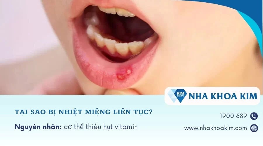 Tại sao bị nhiệt miệng liên tục, tái đi tái lại nhiều lần?