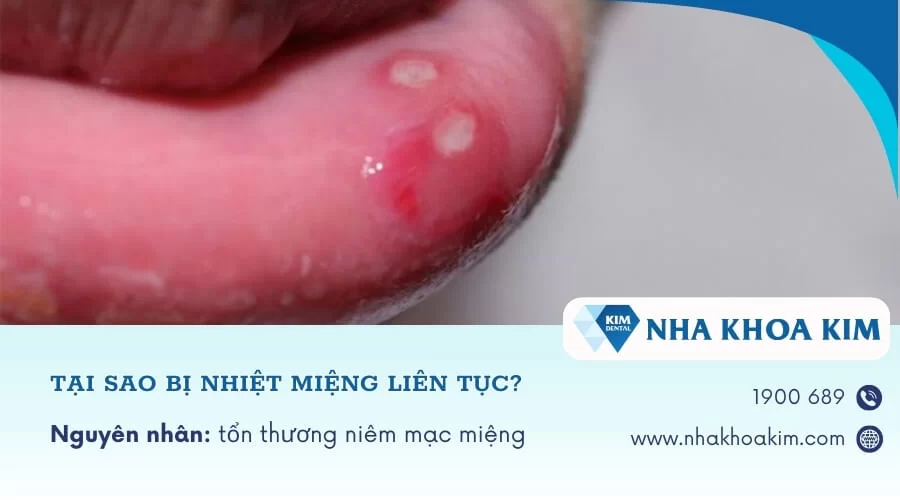 Tại sao bị nhiệt miệng liên tục, tái đi tái lại nhiều lần?