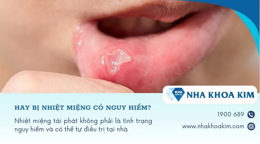 Tại sao bị nhiệt miệng liên tục, tái đi tái lại nhiều lần?