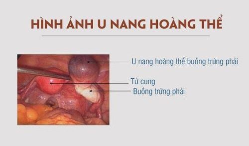 Nang hoàng thể ảnh hưởng đến khả năng mang thai thế nào?