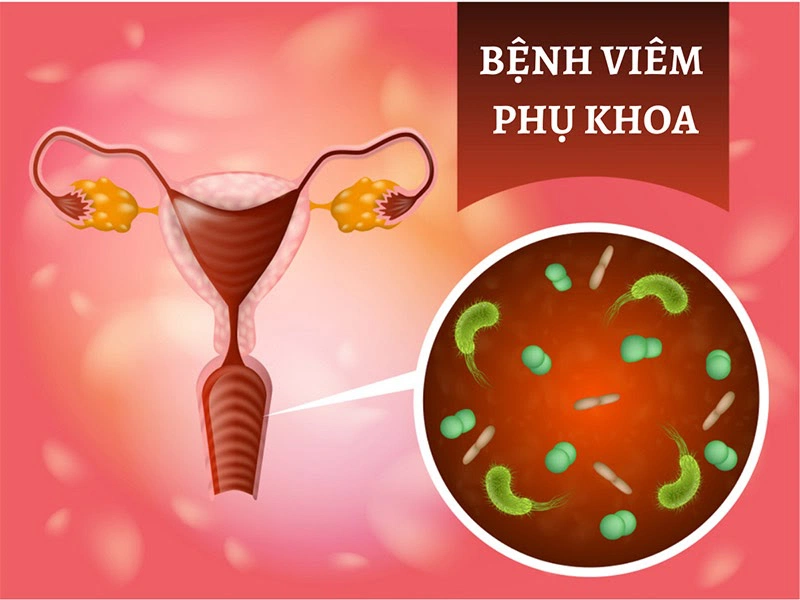 Dấu hiệu viêm phụ khoa nhẹ và cách chữa trị bằng bài thuốc dân gian