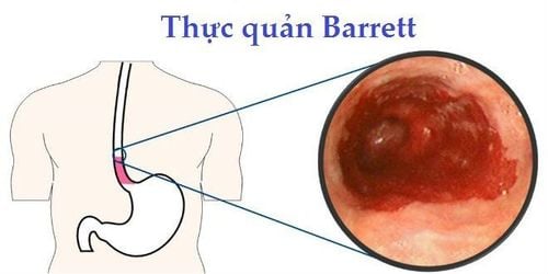 Các bệnh thường gặp ở thực quản