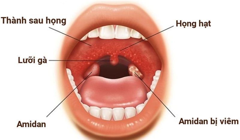 Góc tư vấn: Viêm họng hạt có chữa dứt điểm được không?