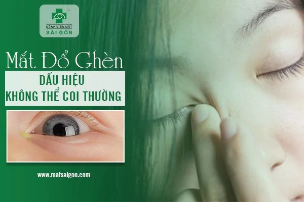 Mắt đổ ghèn dấu hiệu không thể coi thường