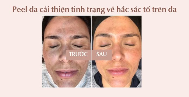 Peel Da Là Gì Có Tốt Không? Có Tác Dụng Gì Đối Với Làn Da?