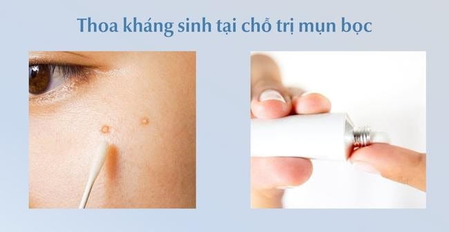 Mụn bọc bao lâu thì chín? Mụn bọc có tự xẹp được hay không?