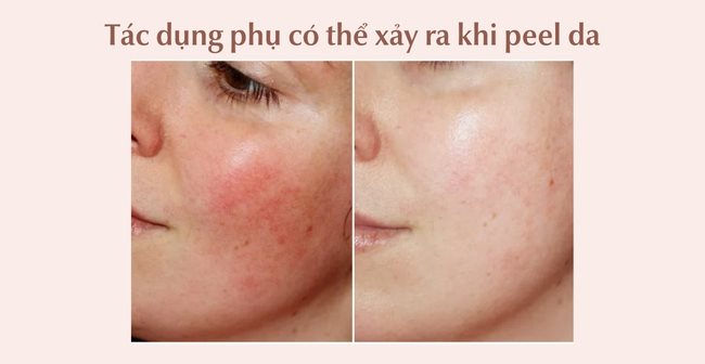 Peel Da Là Gì Có Tốt Không? Có Tác Dụng Gì Đối Với Làn Da?