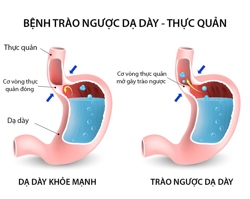 Top những thuốc trị trào ngược dạ dày được sử dụng nhiều nhất hiện nay