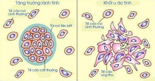 Khối u ác tính khác khối u lành như thế nào?