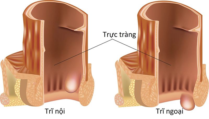 Top 7 dấu hiệu bệnh trĩ ngoại dễ nhận biết nhất