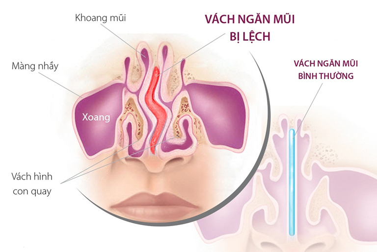 Nguyên nhân chảy máu cam ở người lớn