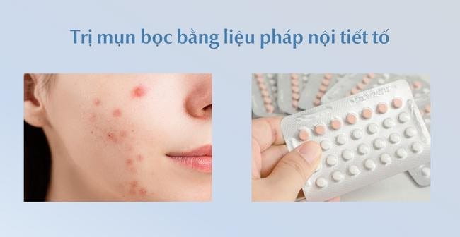 Mụn bọc bao lâu thì chín? Mụn bọc có tự xẹp được hay không?