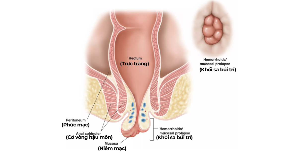 Sa búi trĩ: Nguyên nhân, triệu chứng, cách điều trị và phòng tránh