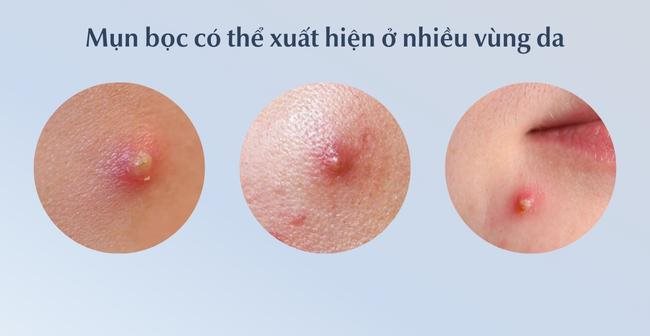 Mụn bọc bao lâu thì chín? Mụn bọc có tự xẹp được hay không?