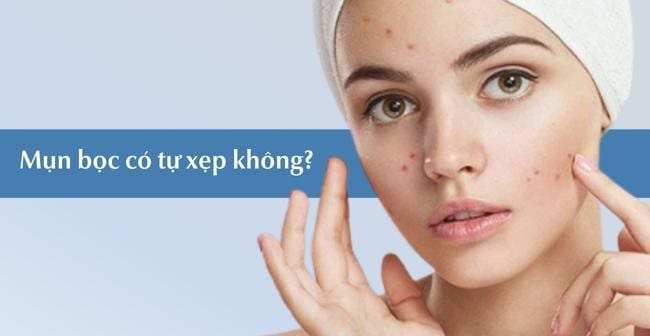 Mụn bọc bao lâu thì chín? Mụn bọc có tự xẹp được hay không?