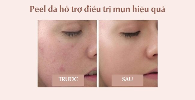 Peel Da Là Gì Có Tốt Không? Có Tác Dụng Gì Đối Với Làn Da?