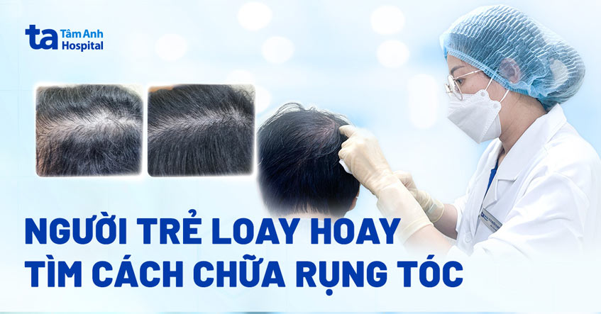 Người trẻ loay hoay tìm cách chữa rụng tóc