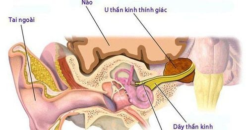 Điều trị khi bị ù tai