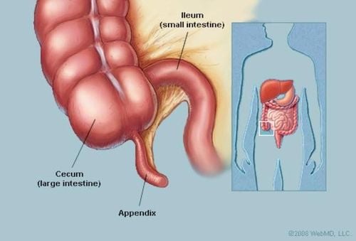 Nhận biết sớm các dấu hiệu đau ruột thừa