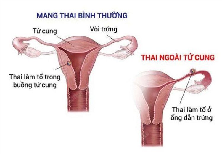 Khí hư có máu: Đừng chủ quan