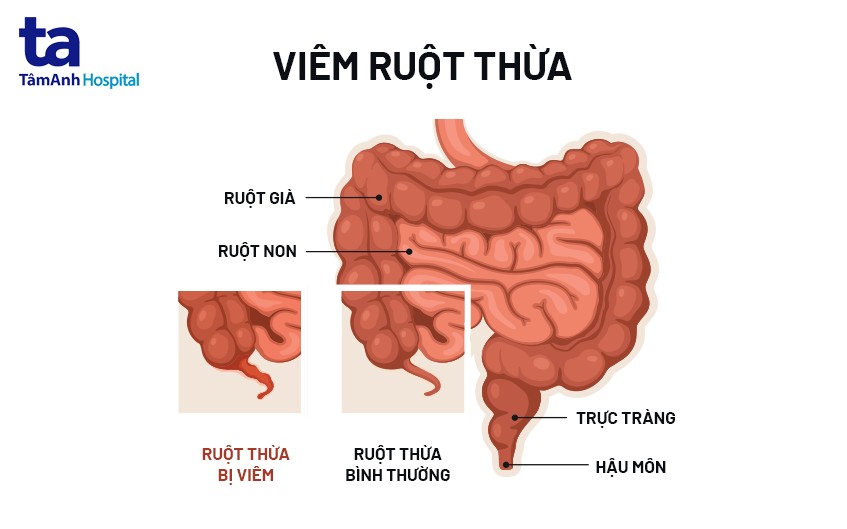 Dấu hiệu đau ruột thừa: Nhận biết nguyên nhân và cách phòng ngừa