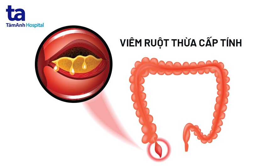 Dấu hiệu đau ruột thừa: Nhận biết nguyên nhân và cách phòng ngừa