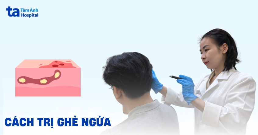 17 cách trị ghẻ ngứa tại nhà an toàn, hiệu quả, dễ áp dụng