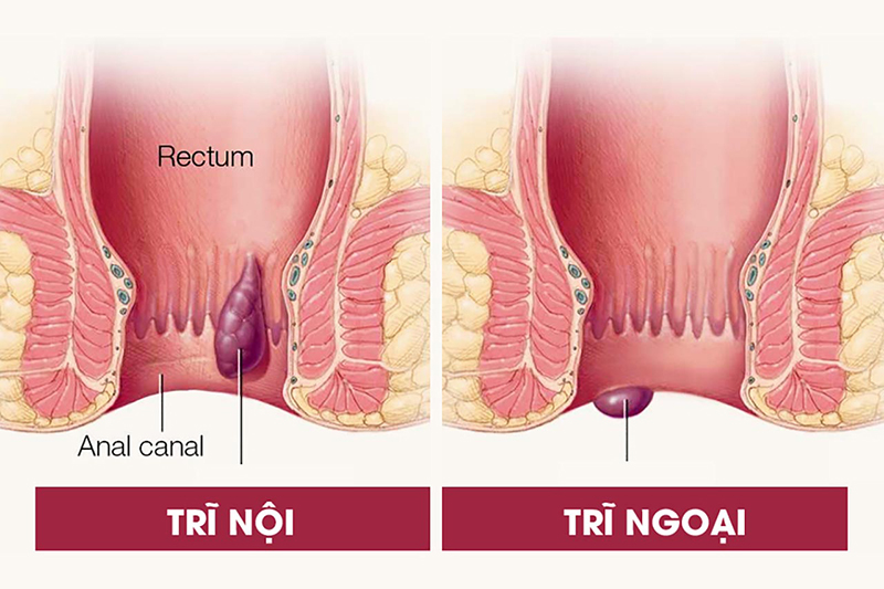 Bệnh trĩ có tự khỏi được không và bằng biện pháp nào?