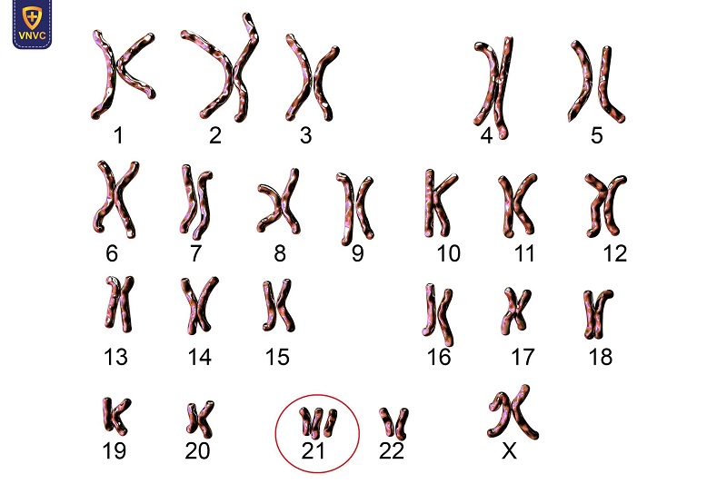 Hội chứng Down: Nguyên nhân, triệu chứng, điều trị và cách phòng ngừa