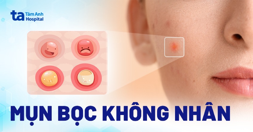 Mụn bọc không đầu (nhân): Nguyên nhân, triệu chứng, điều trị