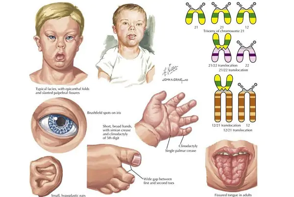 Hội chứng bệnh down và những điều mẹ bầu cần nắm rõ