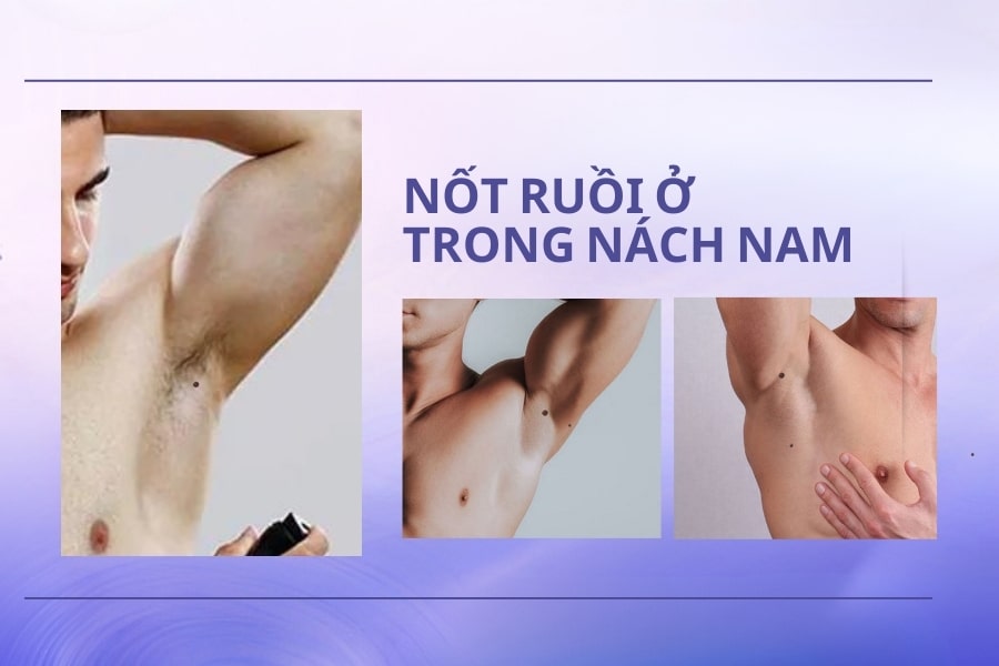 Nốt ruồi ở nách mang ý nghĩa tốt hay xấu? Có nên xóa không?