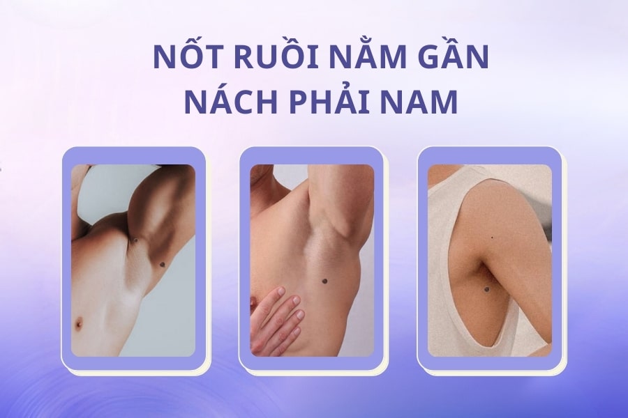 Nốt ruồi ở nách mang ý nghĩa tốt hay xấu? Có nên xóa không?