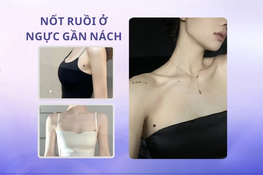 Nốt ruồi ở nách mang ý nghĩa tốt hay xấu? Có nên xóa không?