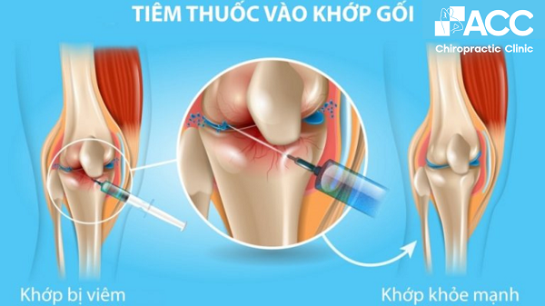 Đau đầu gối: Nguyên nhân, phương pháp điều trị và phòng ngừa